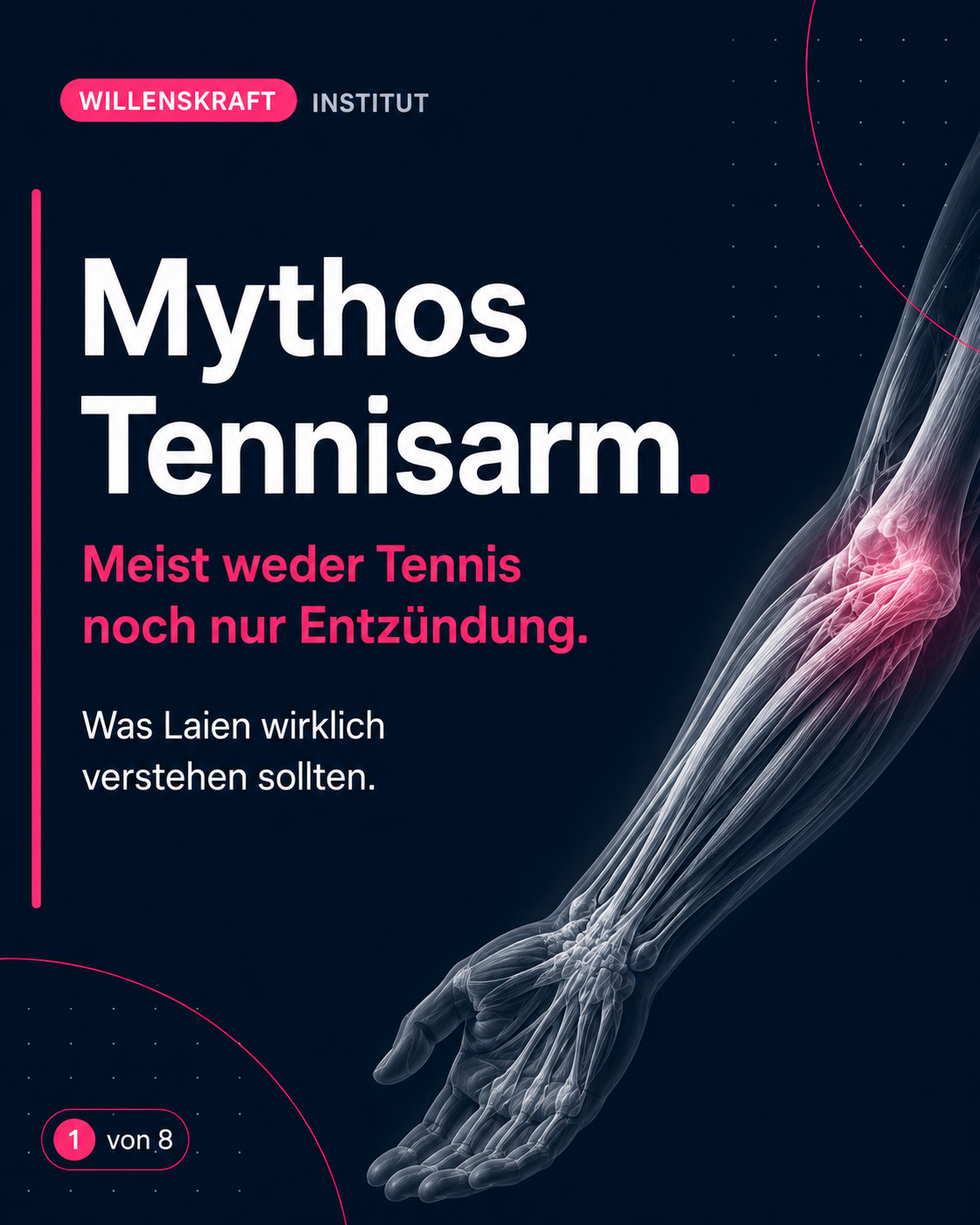 Mythos Tennisarm. Meist ist weder Tennis noch nur Entzündung der Grund.