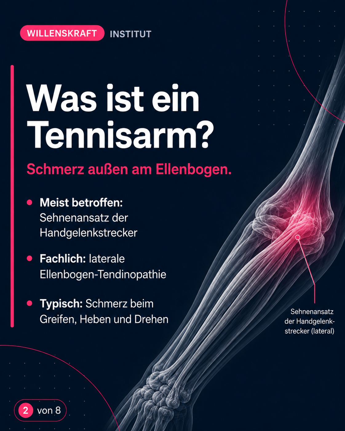 Was ist ein Tennisarm? Schmerz außen am Ellenbogen mit Schmerzen beim Greifen, Heben und Drehen.